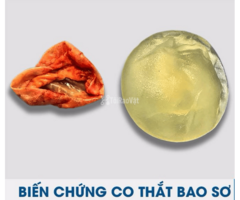 Xử lý co thắt bao xơ sau nâng ngực Những điều cần biết